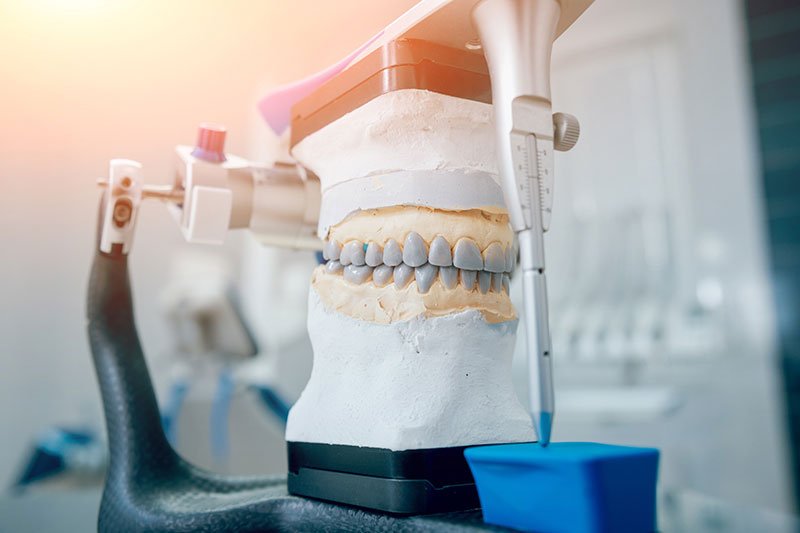 Cosmetic dental case mounted on articulator in the lab.