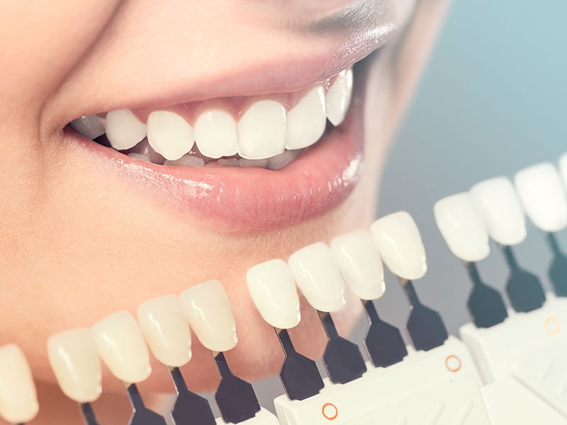 Cosmetic Dentistry | Century Smile Dental Practice | Culver City, CA