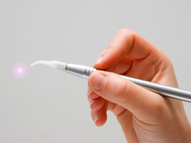 Laser Dentistry | Century Smile Dental Practice | Culver City, CA