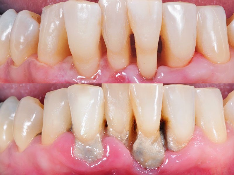 Periodontics | Century Smile Dental Office | Culver City, CA